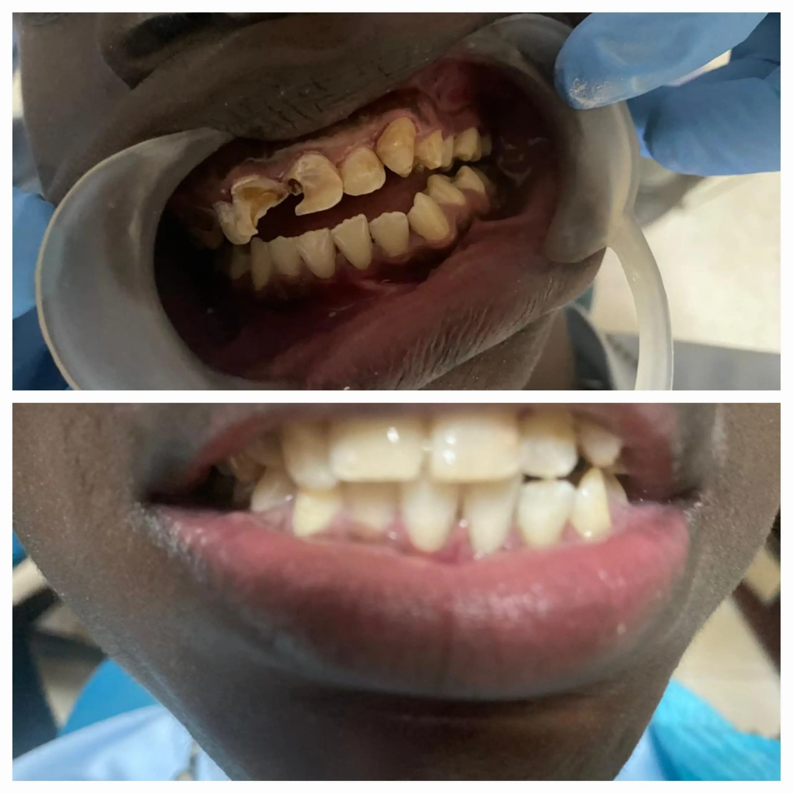 Fillings done at Sterling Dental Clinic